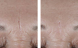 InterFuse Treatment Cream FACE & NECK 1.7 pz